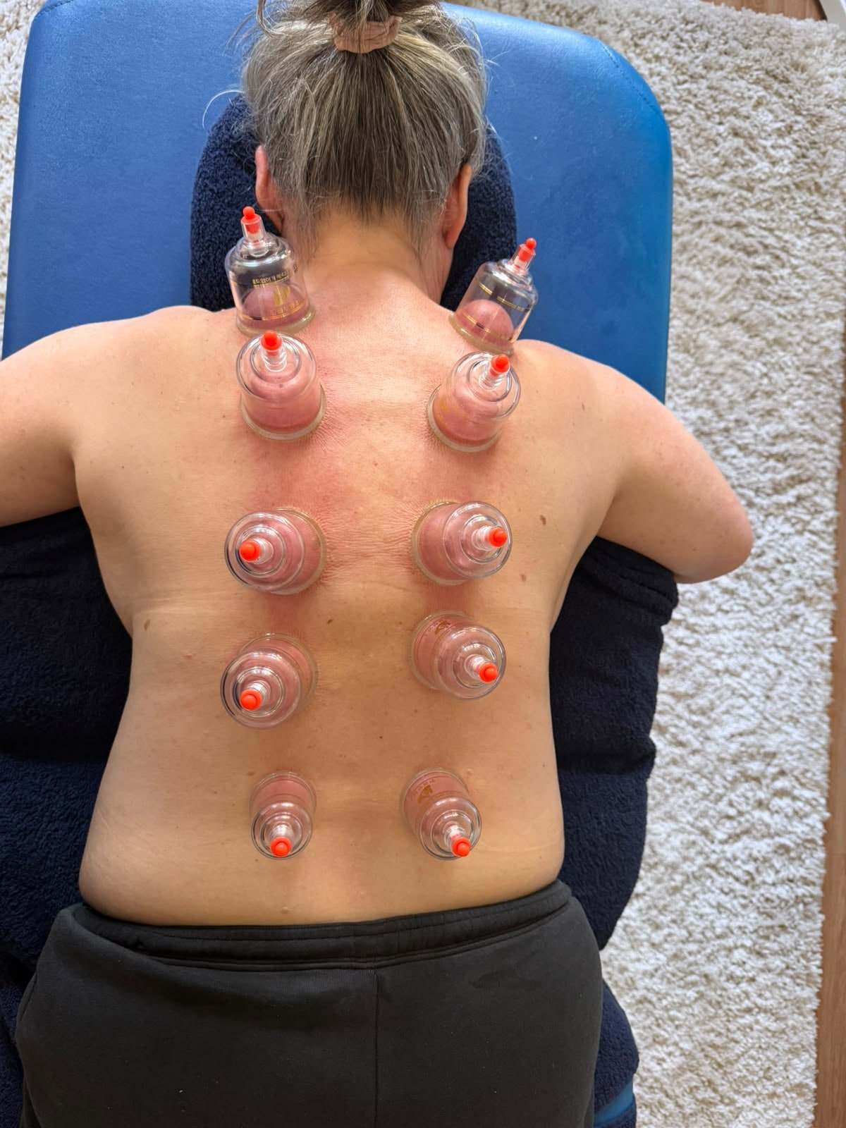 Myofascial cupping cups placed in two rows along a client’s spine